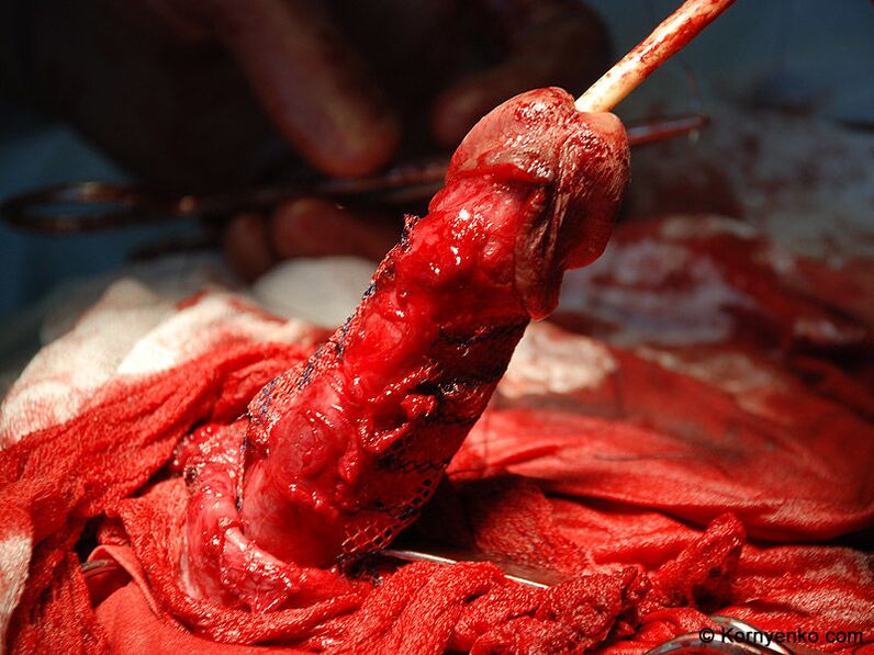 kolagēna matricas uzstādīšana dzimumlocekļa paplašināšanai