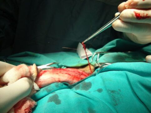 dzimumlocekļa paplašināšanas operācija