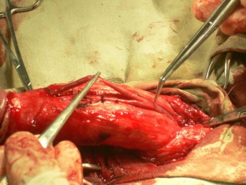 veic dzimumlocekļa paplašināšanas operāciju