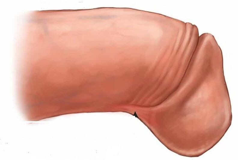 kā palielināt dzimumlocekļa glans